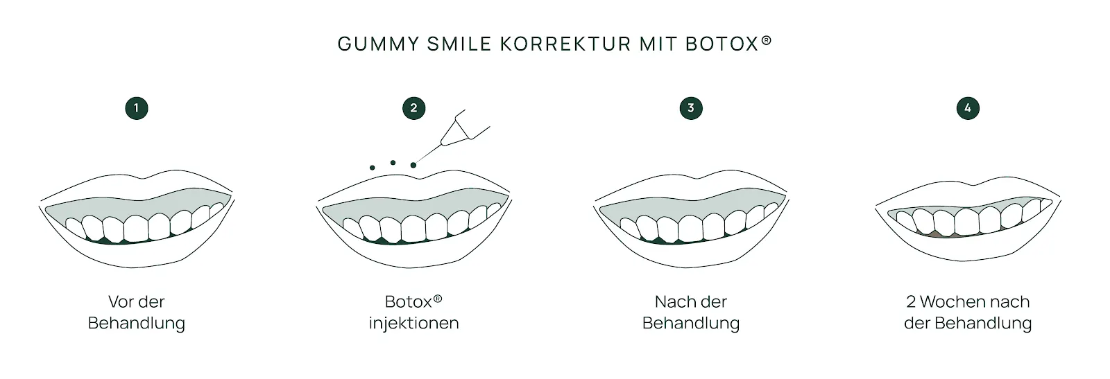Schaubild Gummy Smile Korrektur mit Botox®: Lächeln vor der Behandlung, Injektionspunkte, nach der Behandlung und zwei Wochen danach