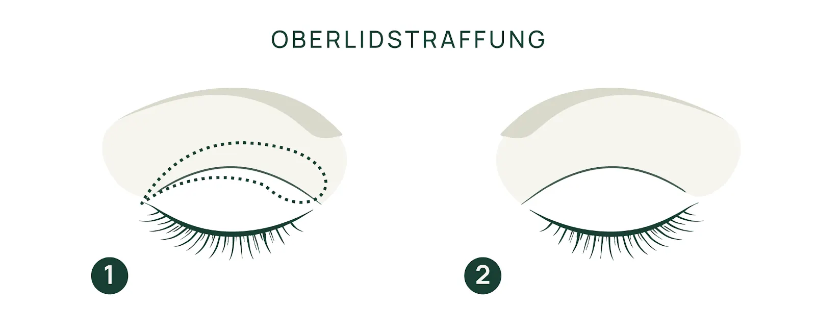 Schaubild Oberlidstraffung: Oberlid mit markiertem Hautüberschuss und Oberlid nach der Straffung